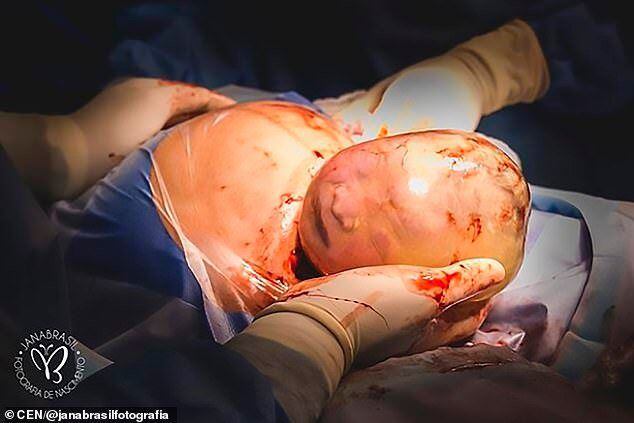 Así nace un bebé 'enmantillado' | Fotos 