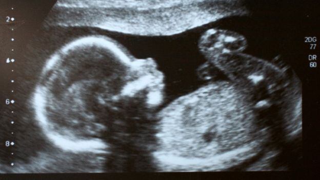 Realizan cesárea a bebé recién nacida 'embarazada' del feto de su hermano gemelo