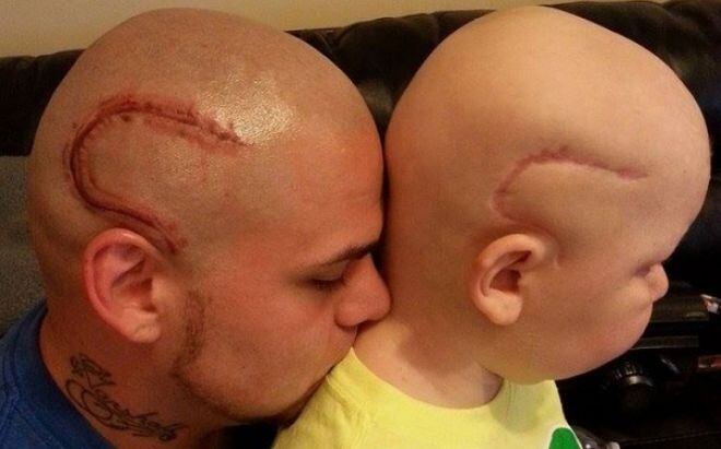 Muere niño cuyo padre se tatuó una cicatriz como la suya