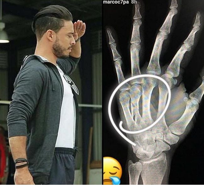 ¡OH, NOOO! Marco Oses sale de 'Calle 7' ante cirugía de su mano fracturada