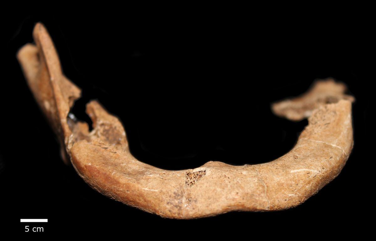 La huella del sufrimiento, en los huesos. Pobladores prehistóricos de Panamá tuvieron enfermedades venéreas y cáncer
