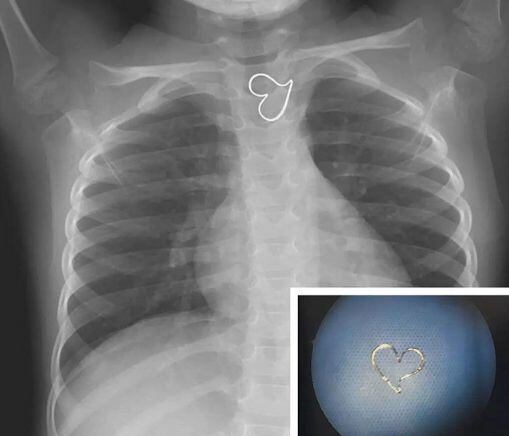 Una niña con dos corazones en su pecho deja asombrados a los doctores