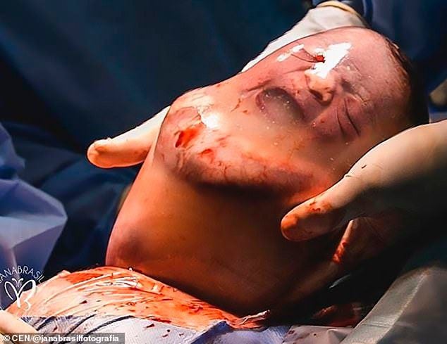 Así nace un bebé 'enmantillado' | Fotos