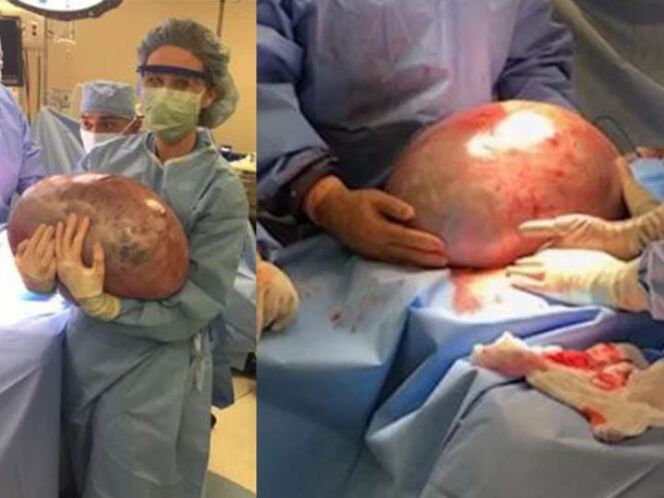 Mujer no adelgazaba, va al hospital y encuentran tumor de 23 kilos 