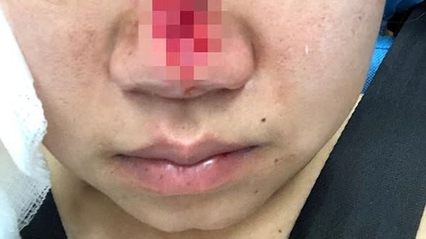 Una mujer le devoró la nariz y ahora debe reunir $12 mil para la cirugía 