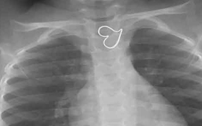 Una niña con dos corazones en su pecho deja asombrados a los doctores