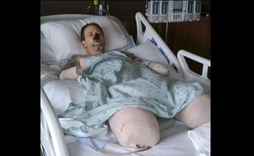 Este hombre quedó mutilado por una bacteria que contrajo de su perro