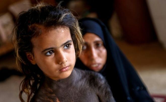 Rara enfermedad aísla a una niña en un pueblo de Irak