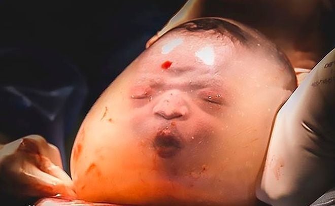 Así nace un bebé 'enmantillado' | Fotos 