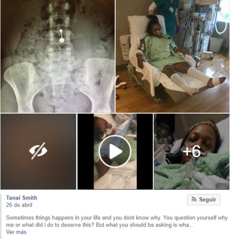 Mujer pierde los dedos del pie y casi la vida por usar un DIU que se le rompió 
