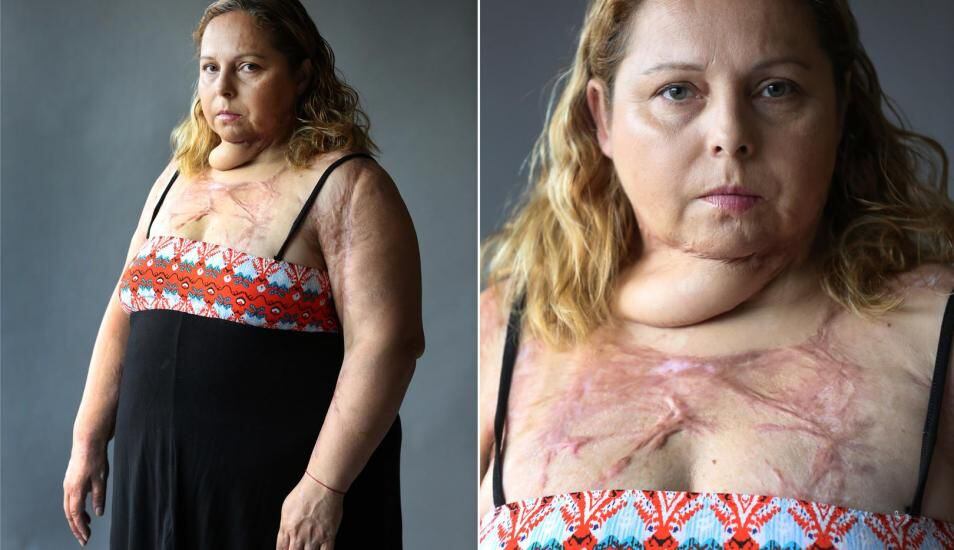 La mujer que pasó por más de 50 operaciones tras  brutal intento de feminicidio